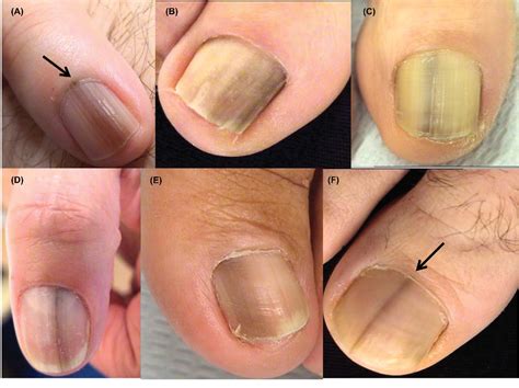 finger nail melanoma images